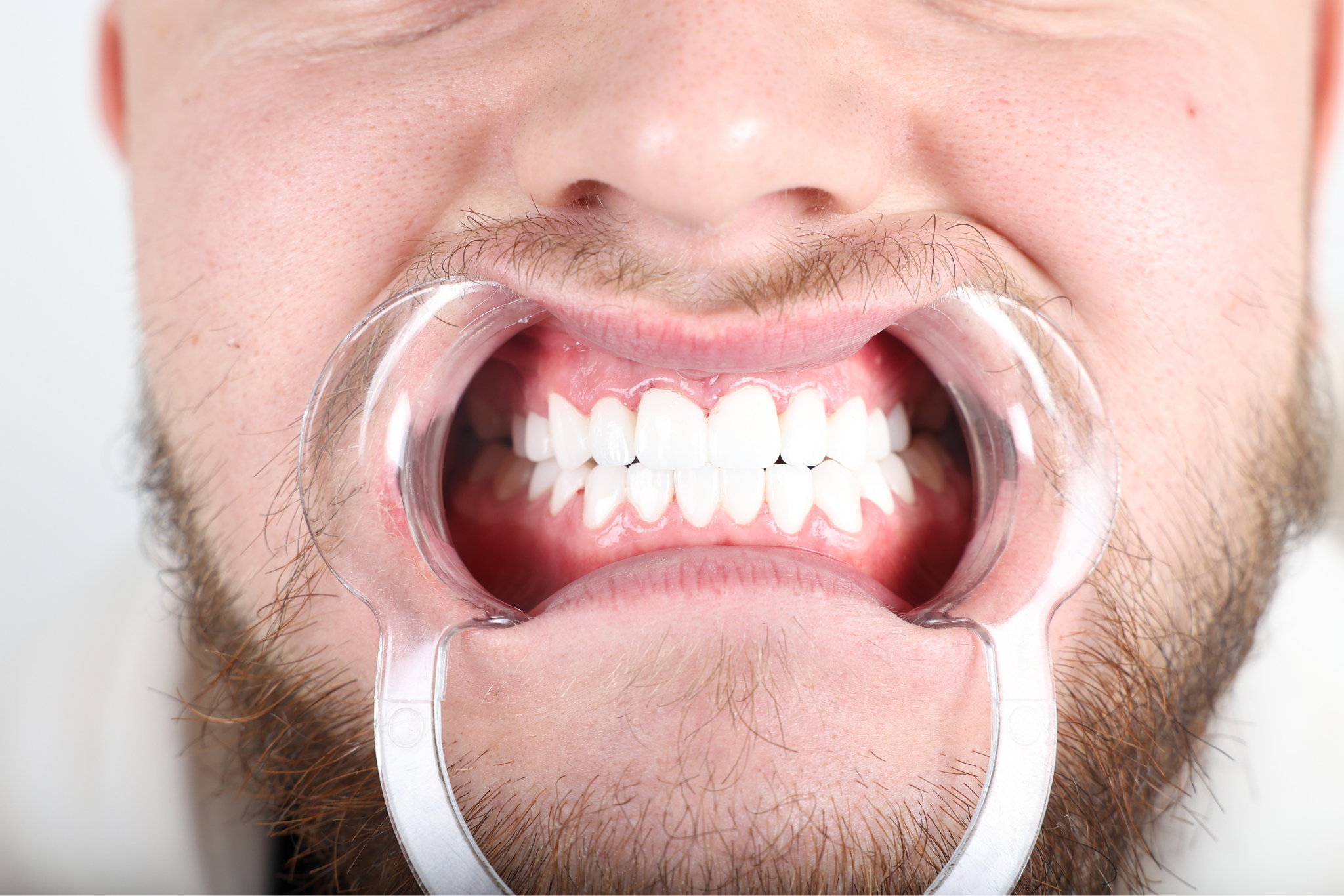 After Zirconia Crown Treatment